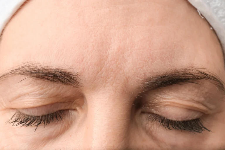 female-forehead-with-wrinkles-2025-02-10-10-05-10-utc