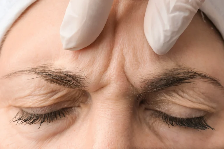 female-forehead-with-wrinkles-2025-02-10-10-46-44-utc
